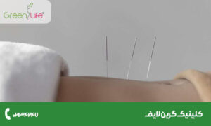 نقاط حساس در طب سوزنی برای لاغری؛ کامل ترین راهنمای علمی 2025